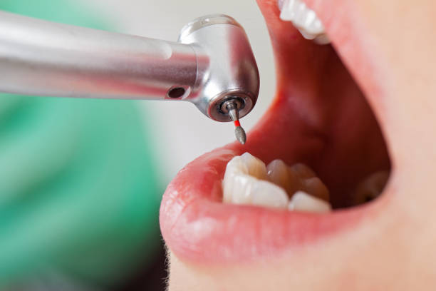 Best Emergency Dental Care for Broken or Chipped Teeth in Nyon Lake, CA